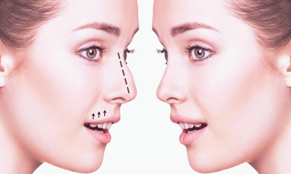 burun-estetigi-rinoplasti-rhinoplasty-01-tender